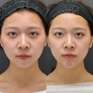 顎ヒアルロン酸ボラックス症例写真の症例写真