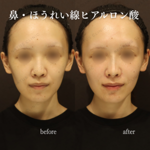 鼻・ほうれい線ヒアルロン酸症例写真の症例写真