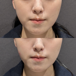 頬こけヒアルロン酸ボリフト症例写真の症例写真