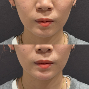 顎ヒアルロン酸ボラックス症例写真の症例写真