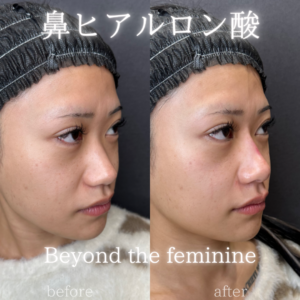 鼻ヒアルロン酸ボラックス症例写真の症例写真