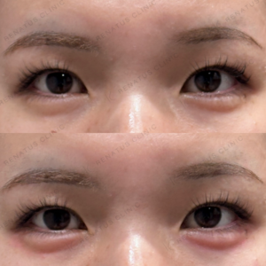 涙袋ヒアルロン酸ボルベラ症例写真|東京田町で涙袋ヒアルロン酸が上手なクリニックの症例写真