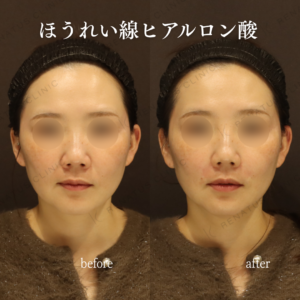 ほうれい線ヒアルロン酸症例写真の症例写真