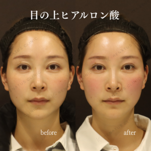 目の上ヒアルロン酸症例写真|目の上のくぼみを改善するならレナトゥスクリニック新宿院の症例写真
