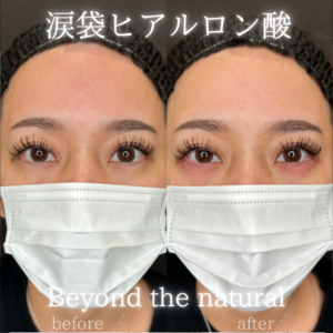 涙袋ヒアルロン酸ボルベラが大阪梅田で人気の症例写真