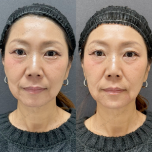 マリオネットライン・顎ヒアルロン酸ボラックス症例写真の症例写真