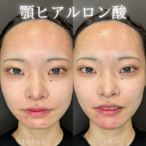 顎ヒアルロン酸ボラックス症例写真の症例写真