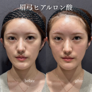 東京田町・新宿で眉弓ヒアルロン酸がうまい。レナトゥスクリニックの症例写真
