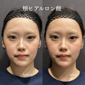 頬コケヒアルロン酸症例写真の症例写真