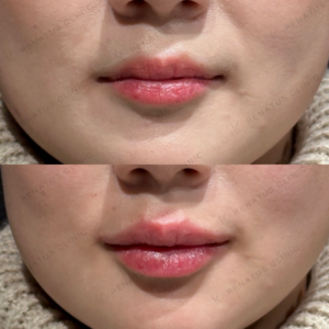 唇ヒアルロン酸症例写真|東京で唇ヒアルロン酸がうまいクリニックの症例写真