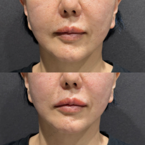 唇ヒアルロン酸ボルベラ症例写真の症例写真