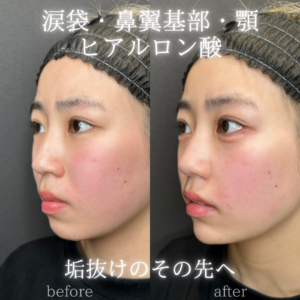 涙袋・鼻翼基部・顎ヒアルロン酸症例写真の症例写真