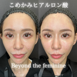 こめかみヒアルロン酸ボリフト症例写真の症例写真