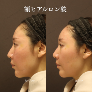 額ヒアルロン酸ボリフト症例写真の症例写真