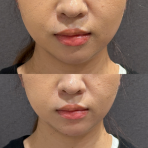 ボラックスヒアルロン酸顎症例写真の症例写真