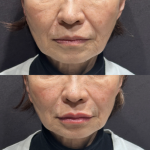 ほうれい線鼻翼基部唇ヒアルロン酸ボリフトボリューマボルベラ症例写真の症例写真