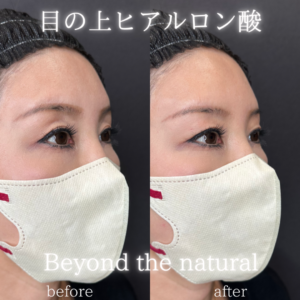 目の上ヒアルロン酸症例写真の症例写真
