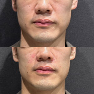 鼻翼基部ヒアルロン酸ボリフトボリューマ症例写真の症例写真