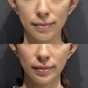 リフトアップヒアルロン酸ボリューマ症例写真の症例写真