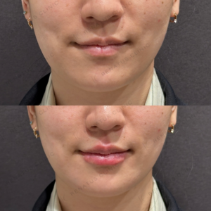 唇ヒアルロン酸ボルベラ症例写真の症例写真