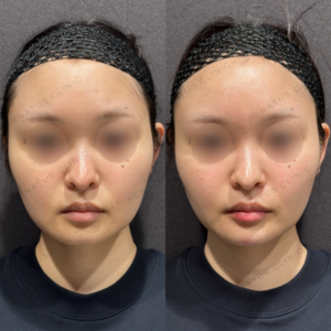 顎ヒアルロン酸ボラックス症例写真の症例写真