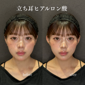 立ち耳ヒアルロン酸症例写真の症例写真