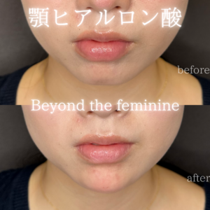 顎ヒアルロン酸症例写真の症例写真