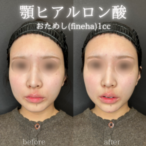 顎ヒアルロン酸ダイヤモンドフィール症例写真の症例写真