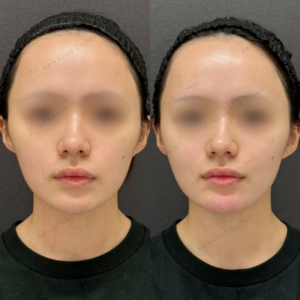 顎ヒアルロン酸ボラックス症例写真の症例写真