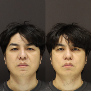 【ほうれい線ヒアルロン酸】溝を浅くし若見えに｜40代男性 ボリフト【東京】の症例写真