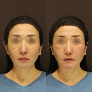 【鼻翼基部ヒアルロン酸】中顔面を短く見せる骨格補正｜40代女性 ボリューマ【東京】の症例写真