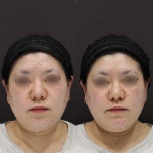 【カスタマイズヒアルロン酸】中顔面〜顎のバランス補正で小顔効果｜30代女性 ダイヤモンドフィール【渋谷区】の症例写真