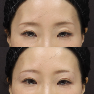 【目の上ヒアルロン酸】影の改善で柔らかい目元に｜30代女性 ボルベラ【新宿】の症例写真