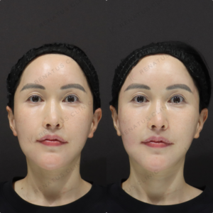 【こめかみ・頬ヒアルロン酸】凹み改善で立体小顔｜30代女性 ボリフト・ボリューマ【新宿】の症例写真