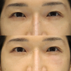 【ゴルゴラインヒアルロン酸】中顔面の影を自然に改善｜40代男性 ボルベラ【代々木】の症例写真