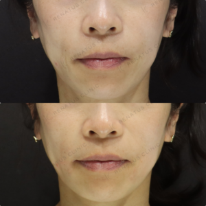 口横ヒアルロン酸症例写真の症例写真