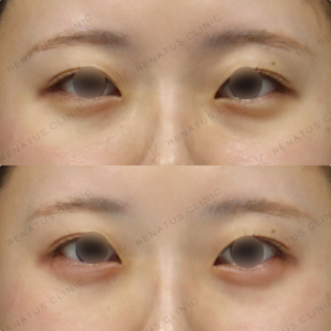 【涙袋ヒアルロン酸】立体感で目元の印象強化｜20代女性 ボルベラ【東京】の症例写真