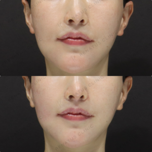 【頬ヒアルロン酸】中顔面の凹み改善で立体小顔｜30代女性 ボリフト【新宿】の症例写真