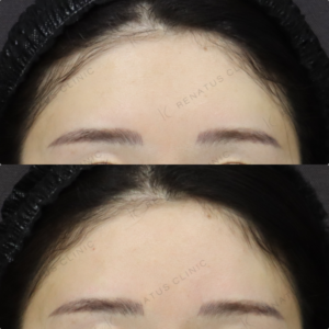 【額ヒアルロン酸】骨格に合わせた立体額｜30代女性 ボリューマ【渋谷区】の症例写真