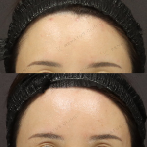 【額ヒアルロン酸】丸いおでこで横顔美人｜30代女性 ボリューマ【新宿】の症例写真