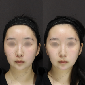 【顎ヒアルロン酸】Eライン整えて輪郭改善｜20代女性 ボラックス【新宿】の症例写真