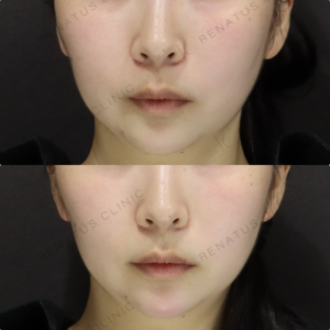 【顎ヒアルロン酸】Eライン強調で横顔美人｜20代女性 ボラックス【東京】の症例写真