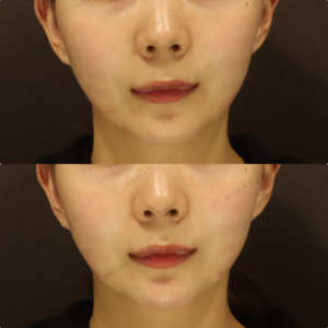 【顎ヒアルロン酸】Eライン強調で横顔美人｜20代女性 ボラックス【東京】の症例写真
