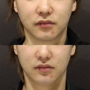 【顎ヒアルロン酸】Eライン整えて輪郭改善｜20代男性 ボラックス【代々木】の症例写真