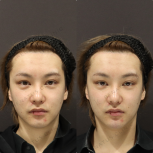 【顎ヒアルロン酸】Eライン整えて輪郭改善｜20代男性 ボラックス【新宿】の症例写真