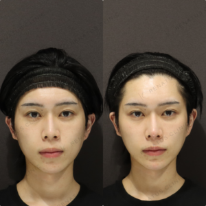 【鼻・顎ヒアルロン酸】鼻筋を通して立体バランス改善｜20代男性ボラックス【代々木】の症例写真