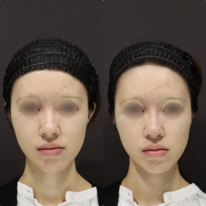 【鼻ヒアルロン酸】骨格に合わせたライン形成｜30代女性 ボラックス【新宿】の症例写真