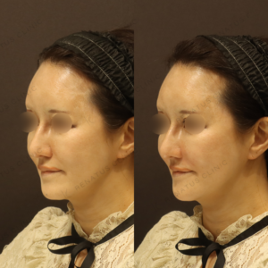 鼻翼基部ヒアルロン酸症例写真の症例写真