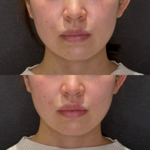 鼻翼基部ヒアルロン酸症例写真｜レナトゥスクリニック　名古屋で上手い安いヒアルロン酸の症例写真