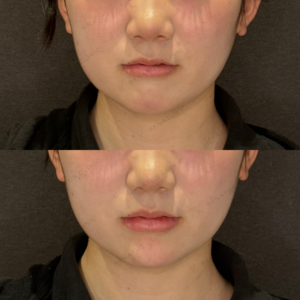 顎ヒアルロン酸症例写真　名古屋ヒアルの名医の症例写真
